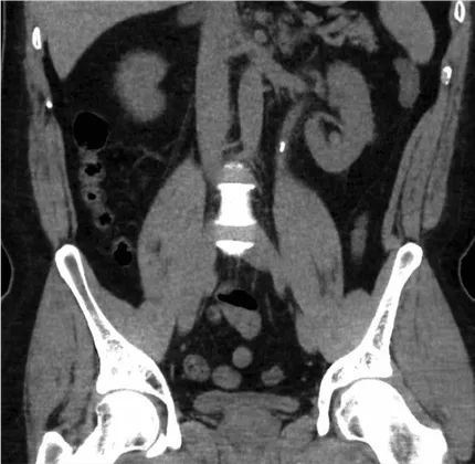 Kidney Stones Symptoms and diagnosis