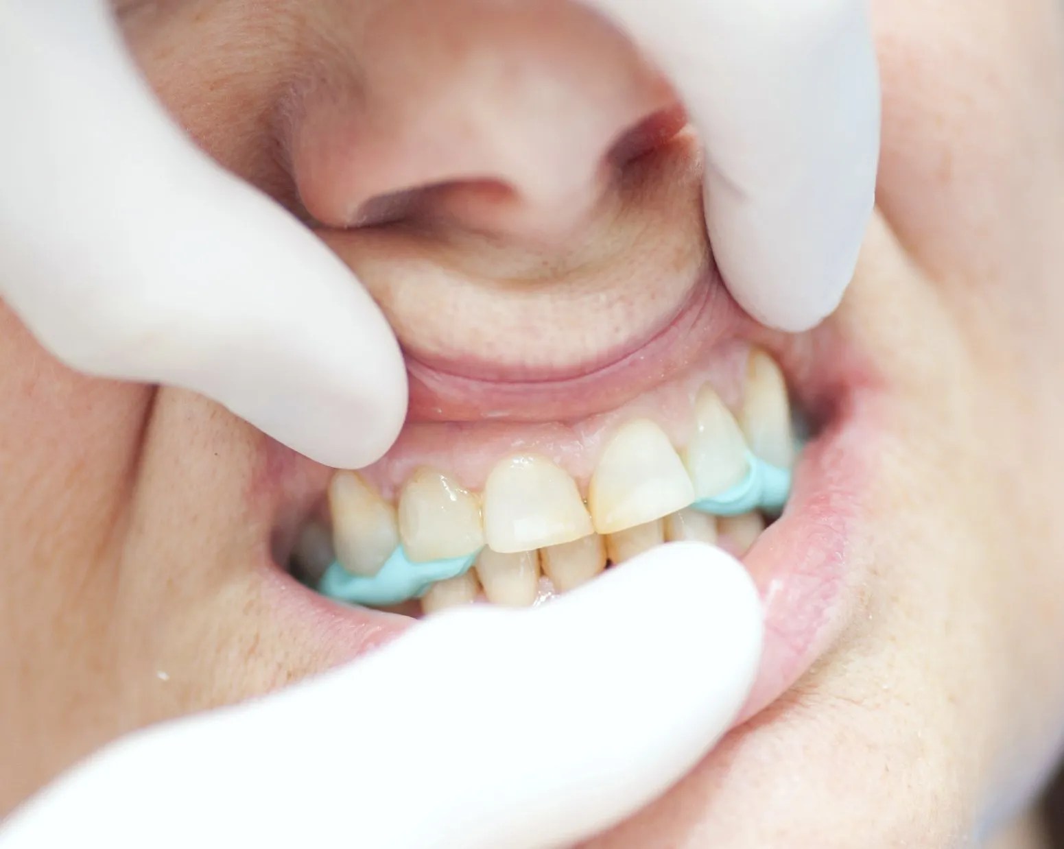 Dentist in Gloucester Abbeymead Dental Care