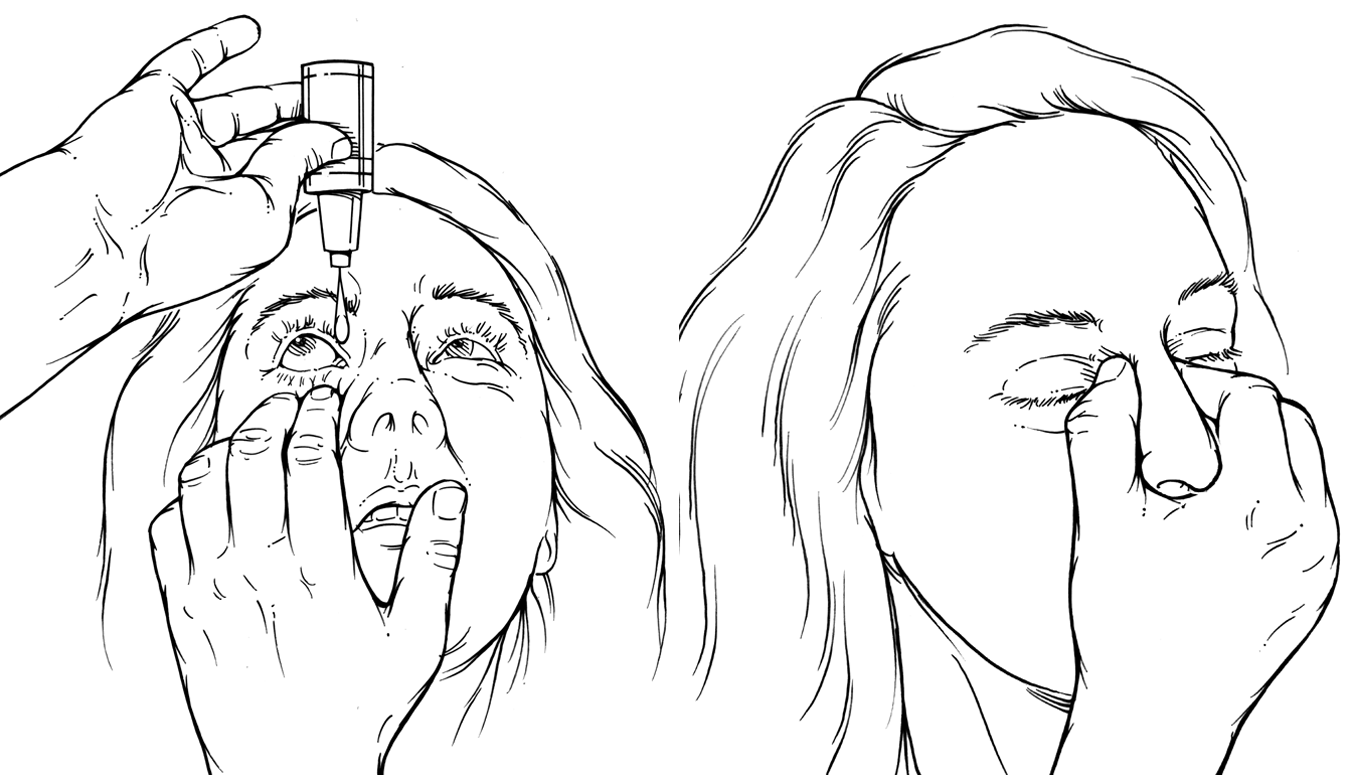 How to succeed at eye drop treatment It’s all in your hands