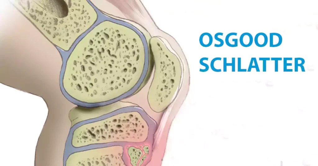 Osgood Schlatter Surgery Everything You Need To Know Learning Physio