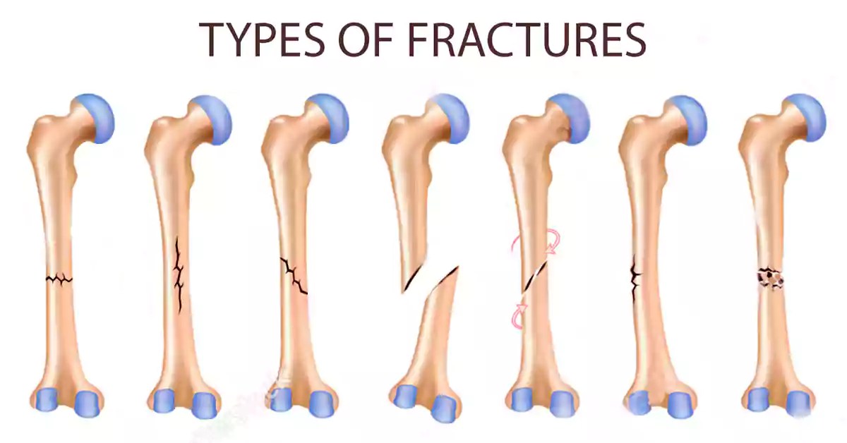 10 Common Types Of Bone Fractures Explained Learning Physio