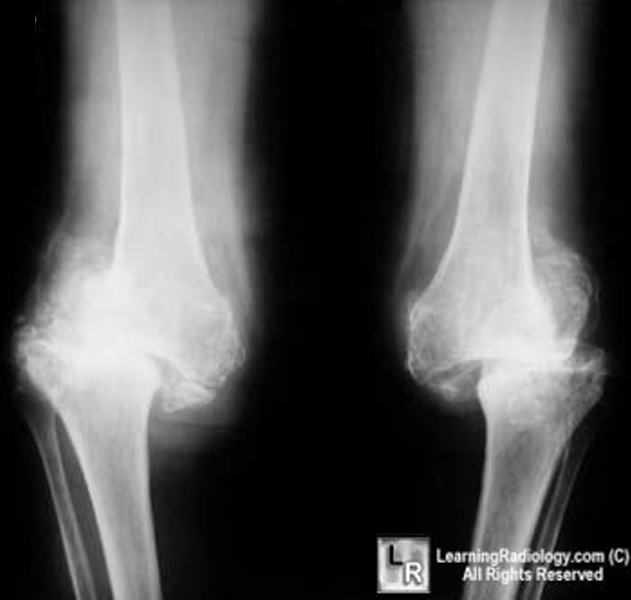 LearningRadiology Charcot Arthropathy, Neuropathic Joint, knee