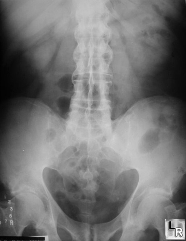 Ankylosing Spondylitis Radiopaedia