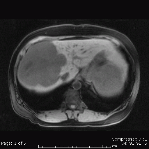 Hemangioma Liver Mri