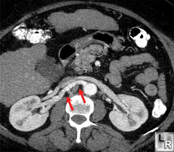 Learning Radiology Fibromuscular Dysplasia