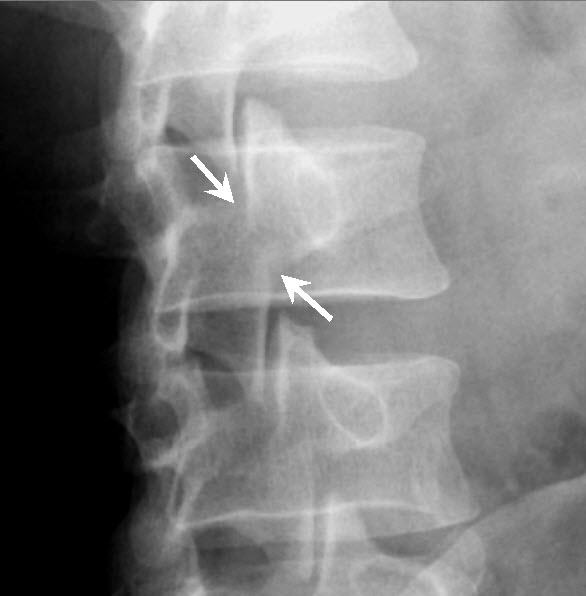 Learning Radiology Spondylolysis