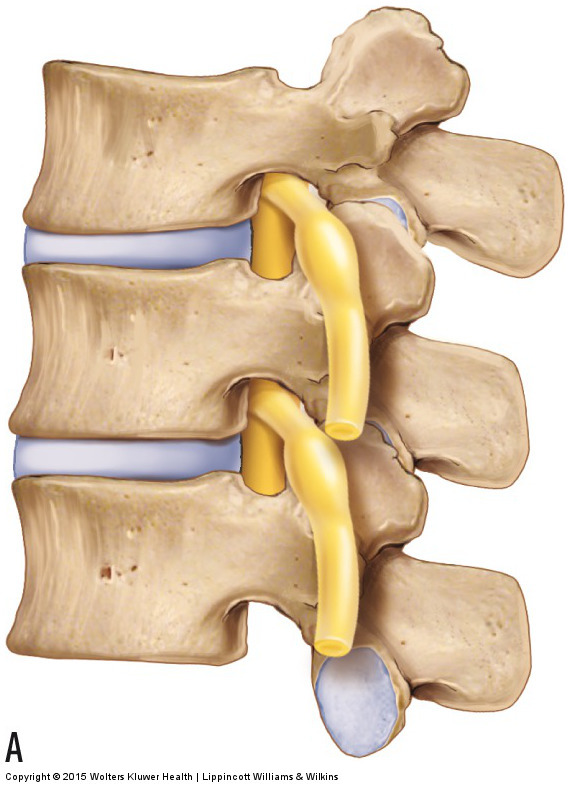 Degenerative Joint Disease (Osteoarthritis) of the Low Back