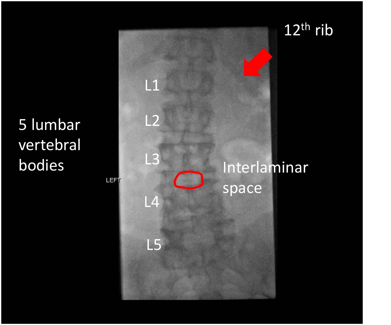 Fluoroscopic guided lumbar puncture Learn Neuroradiology