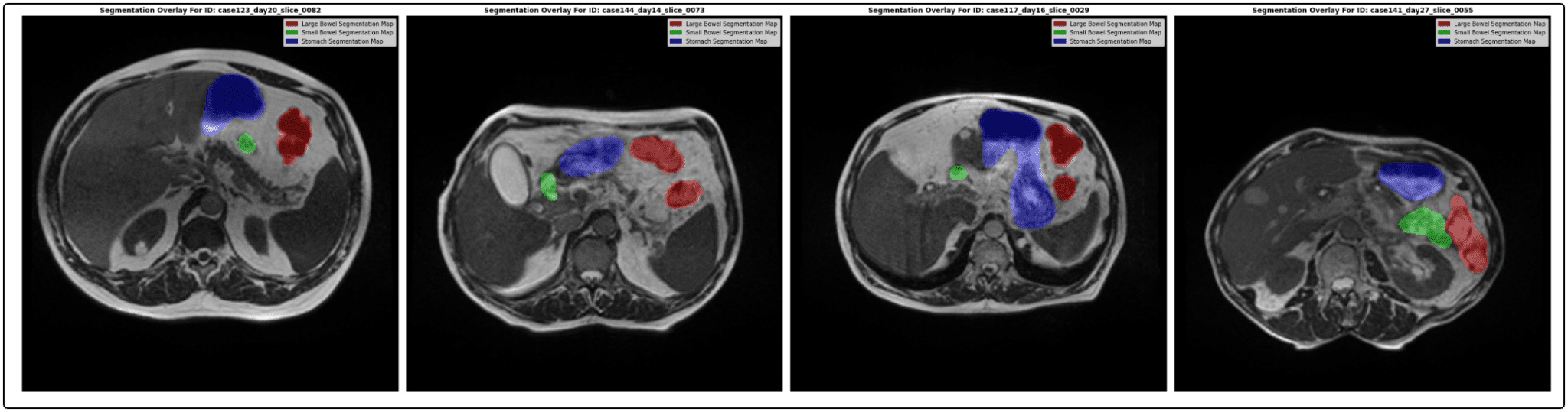 Medical Image Segmentation Using 🤗 HuggingFace & PyTorch