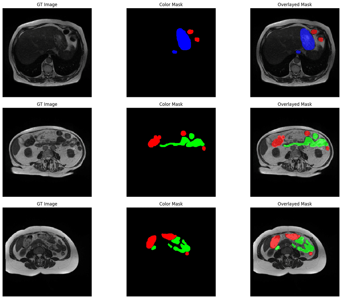 Medical Image Segmentation Using 🤗 HuggingFace & PyTorch