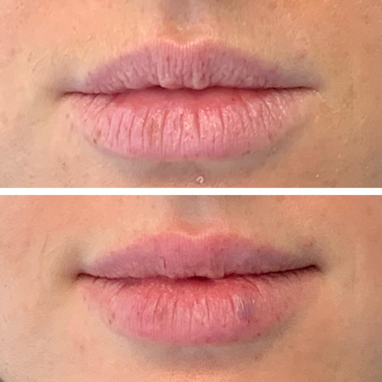 QUÉ SON LOS LIP FILLERS CONOCÉ DOS TÉCNICAS DE RELLENO DE LABIOS! Le