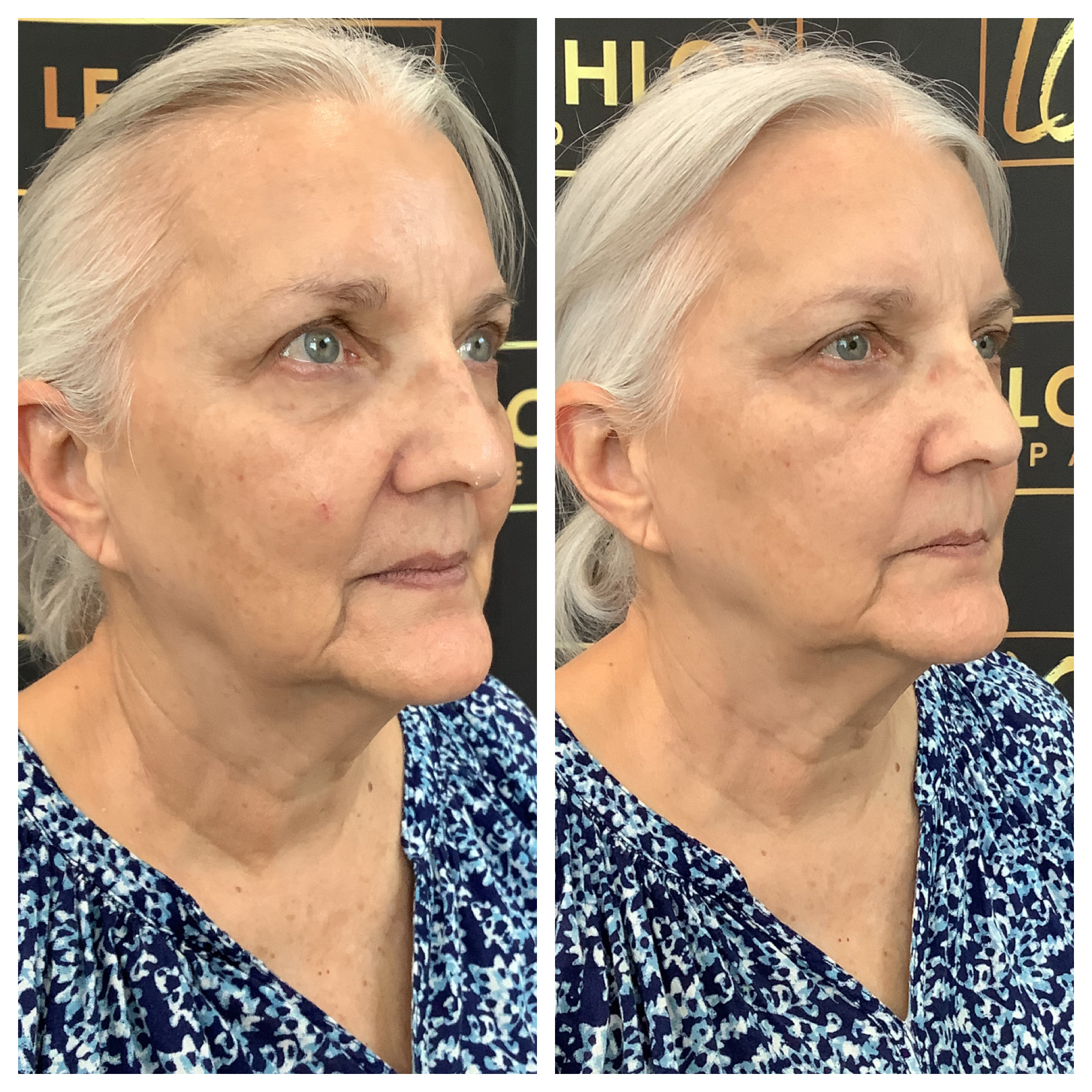 Ultherapy Katy TX Age Defying Treatment Le Chloé Med Spa