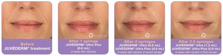 Botox and Juvederm Ledger Dentistry