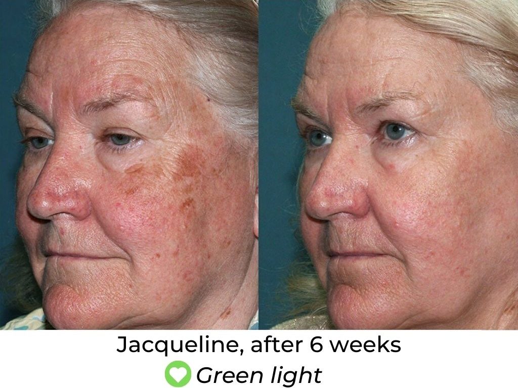 LED Face Mask Before and After LED Skin Solutions