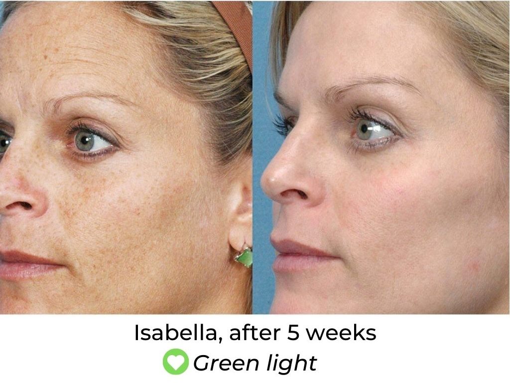 LED Face Mask Before and After LED Skin Solutions