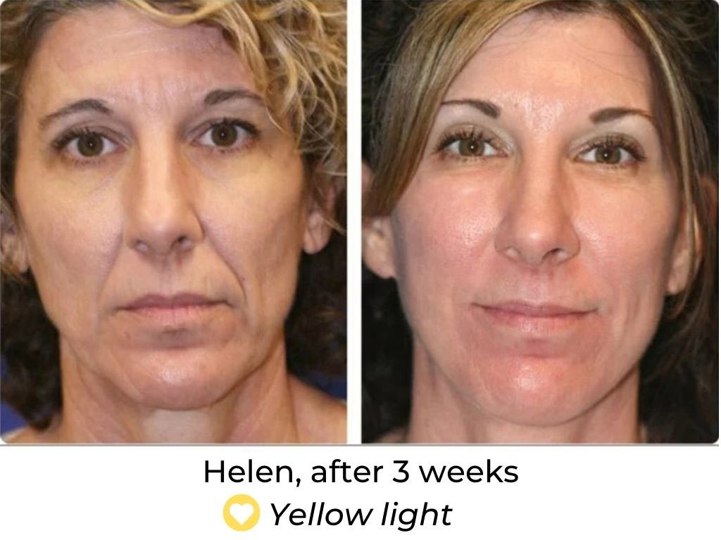 LED Face Mask Before and After LED Skin Solutions
