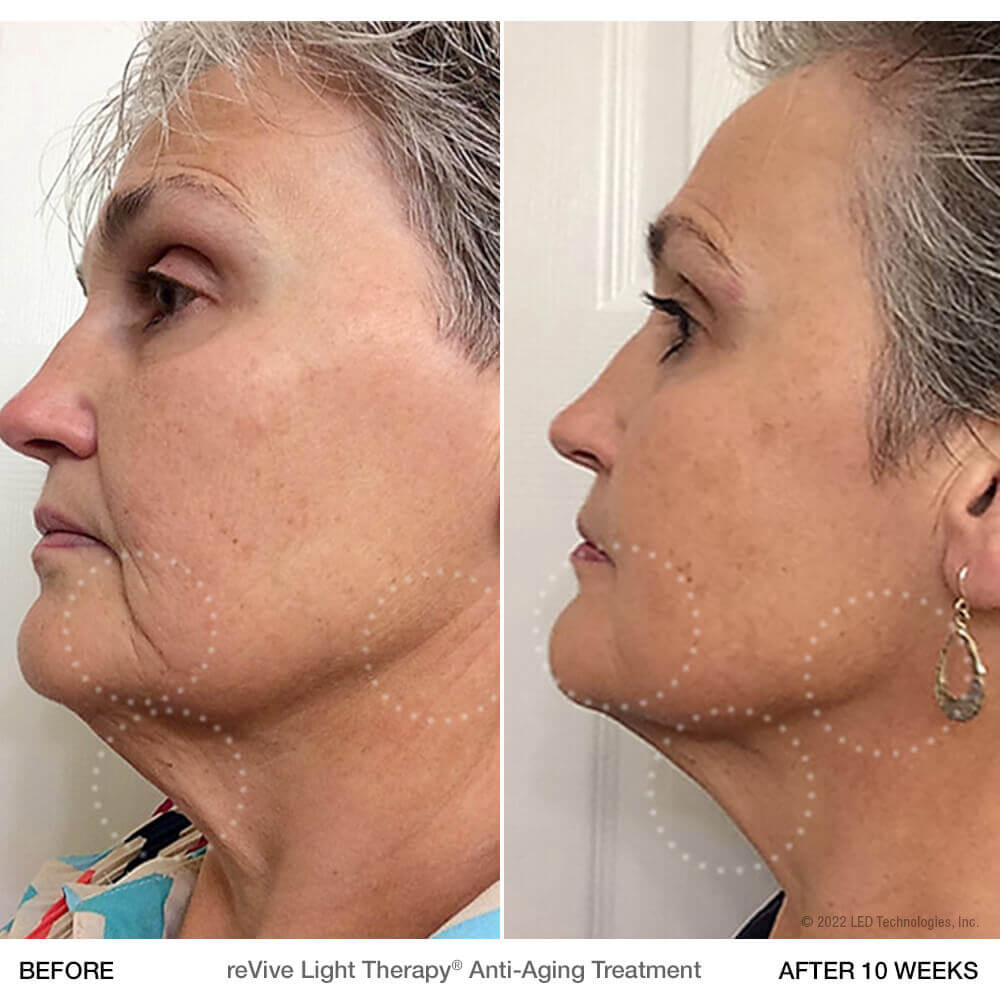 Can Red Light Therapy Slow Aging? Infrared for Health