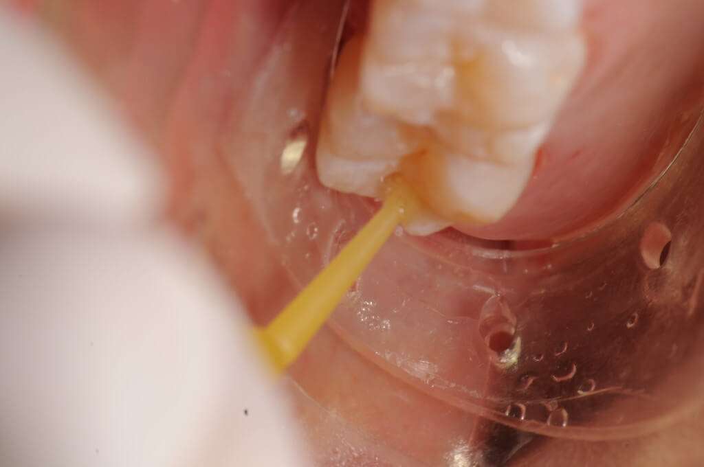 Scrubbing Self Etching Dentin Adhesives Lee Ann Brady DMD