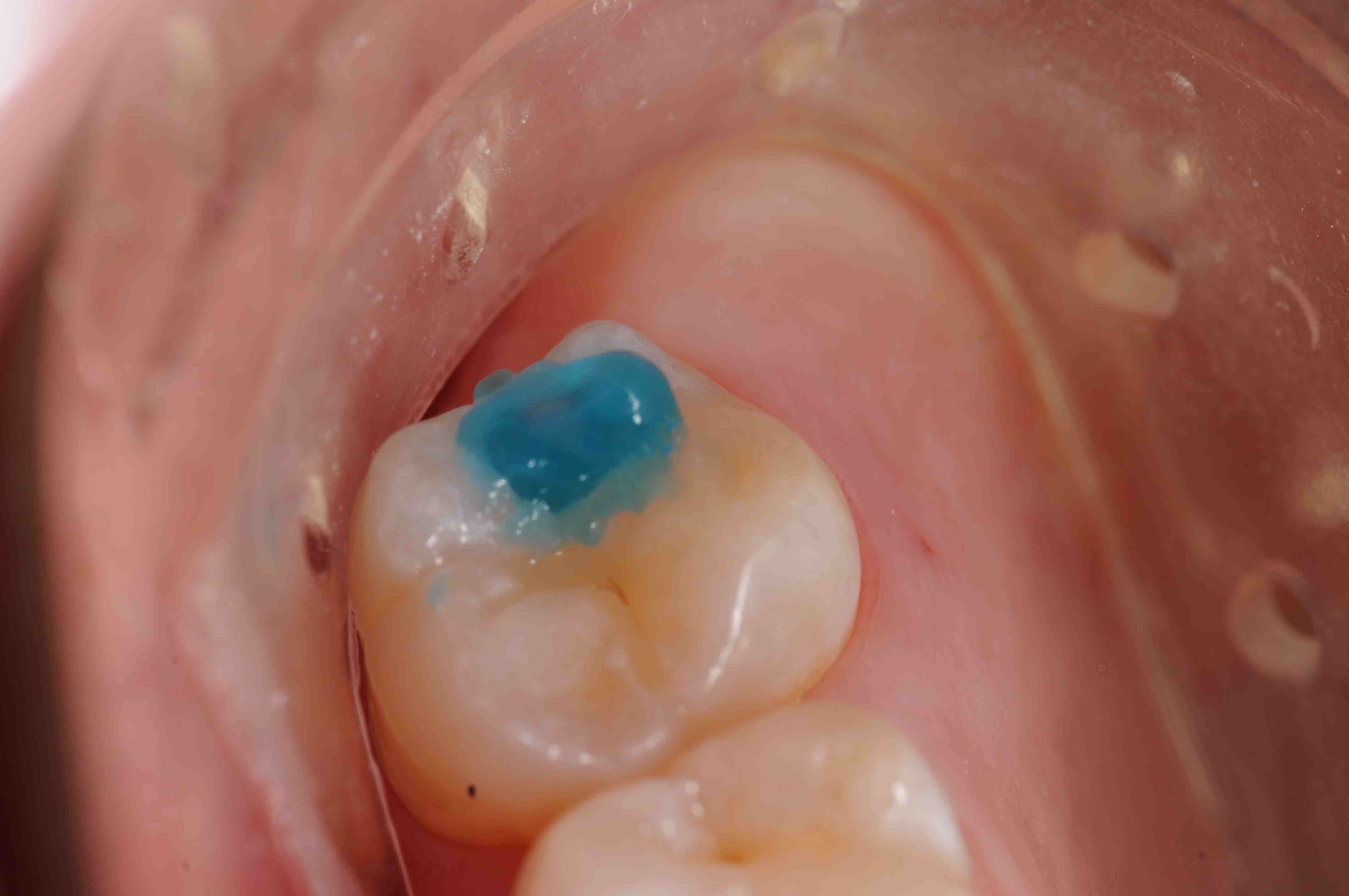 Posterior Composite Post Op Sensitivity Lee Ann Brady DMD