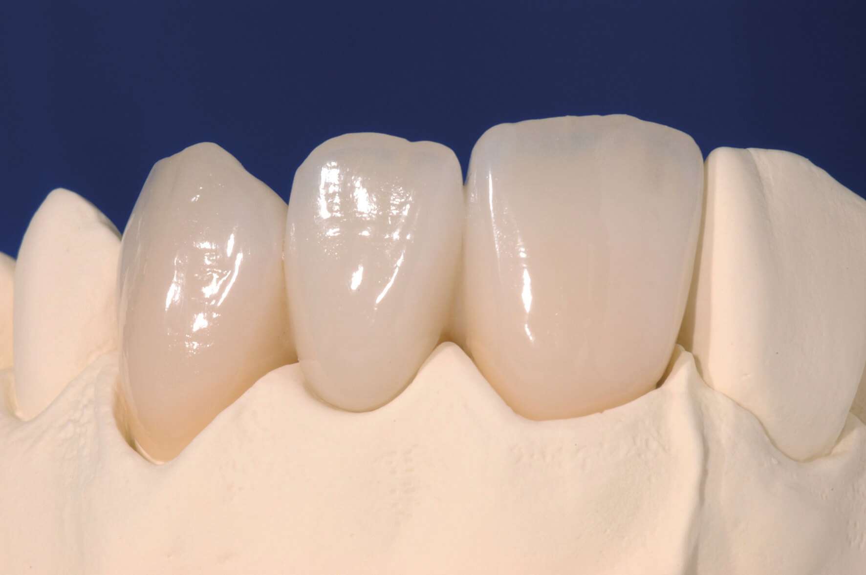 All Porcelain Connector Sizes » Lee Ann Brady, DMD's Dental Blog