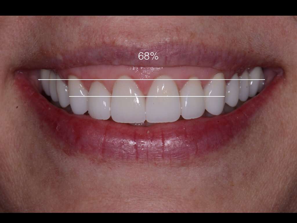 Esthetic Zone Ratios Part One Lee Ann Brady DMD