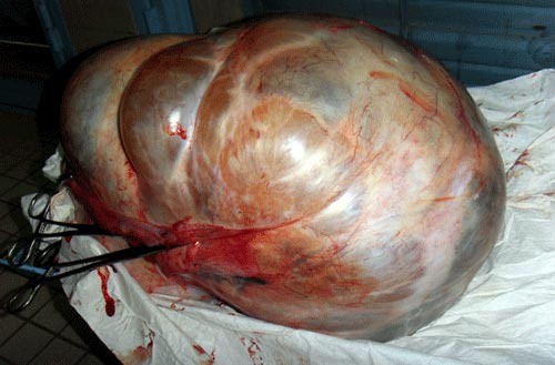 CHR DE BANFORA 11 kilogrammes de kyste ovarien extrait d’une femme
