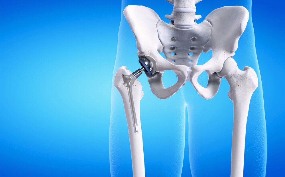 Hip Replacement (RA) All You Need to Know About Hip Replacement