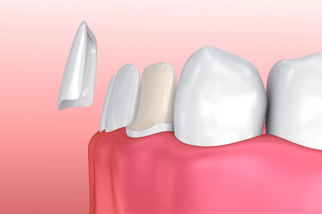 Dental Veneers Process What is Involved and How Long Does It Take?