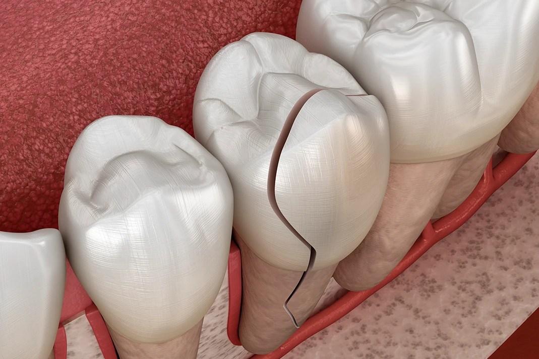 Teeth Chipping Causes, Problems and Solutions