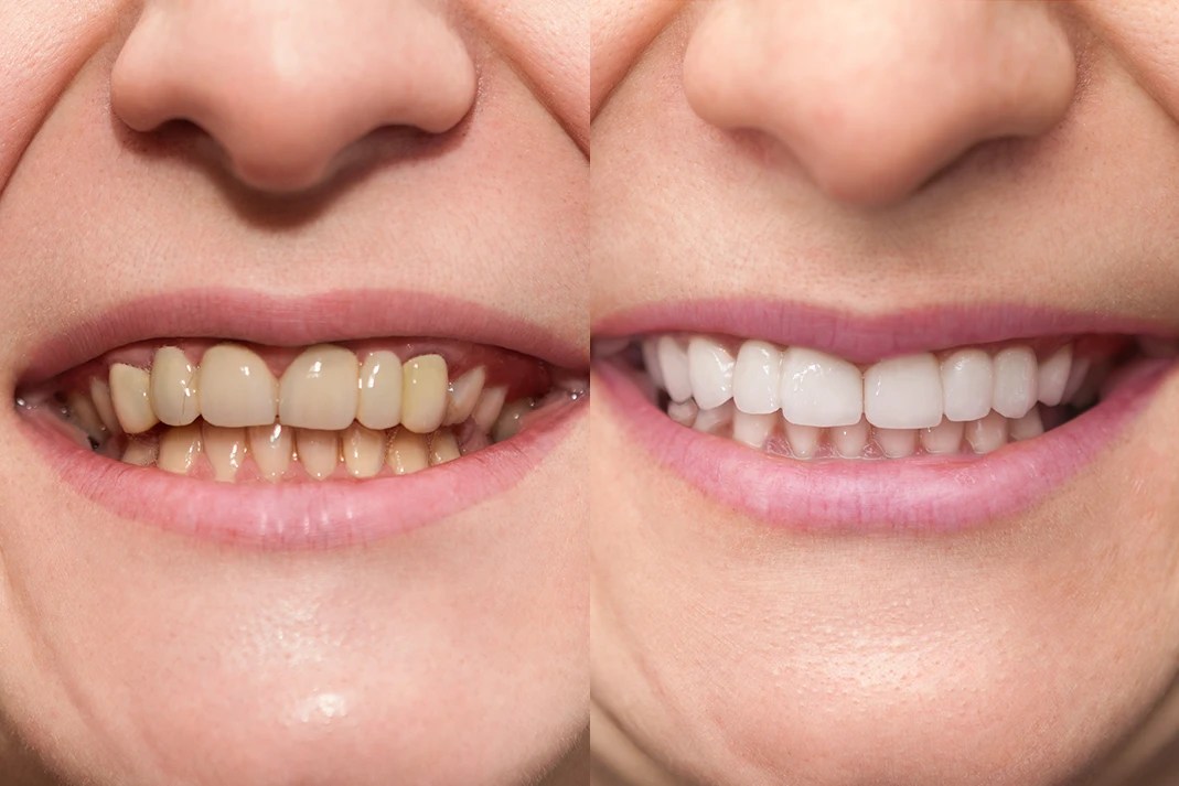 Intrinsic Tooth Stain Causes and Treatments