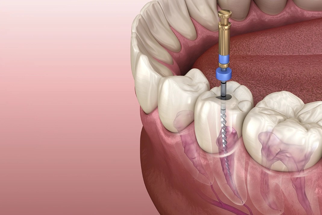 Can a Root Canal Be Done on a Crowned Tooth? When is it Necessary and How It’s Performed?