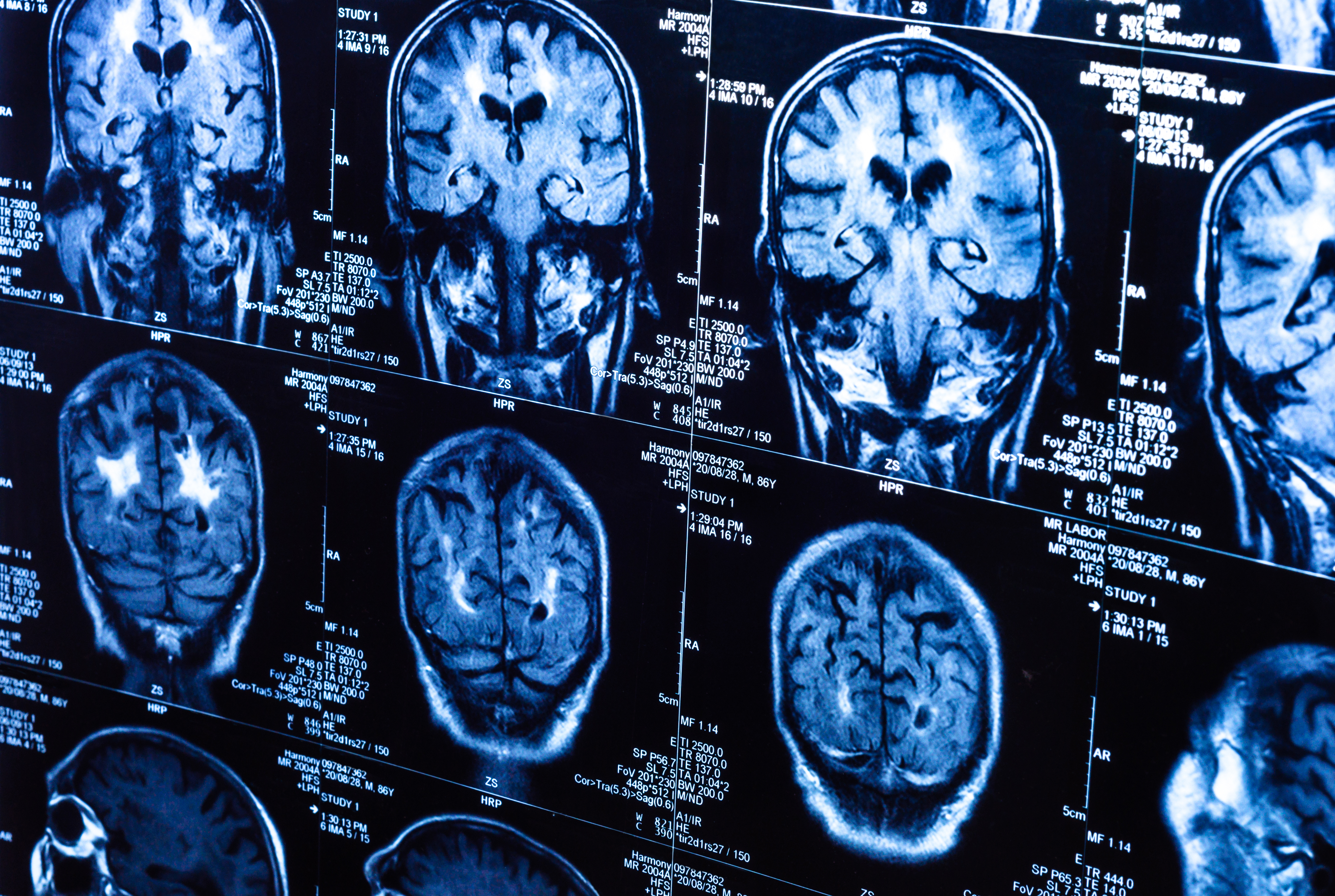 Concussions Lasting Effects Even After You Feel Better