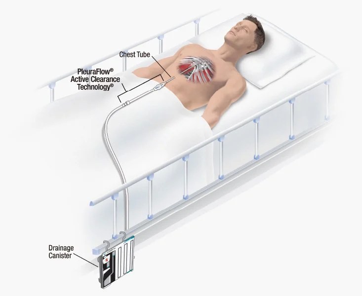 ClearFlow Announces Positive Trial Results for PleuraFlow Thoracic
