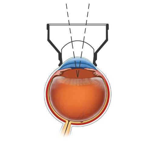 YAG Capsulotomy Lenses