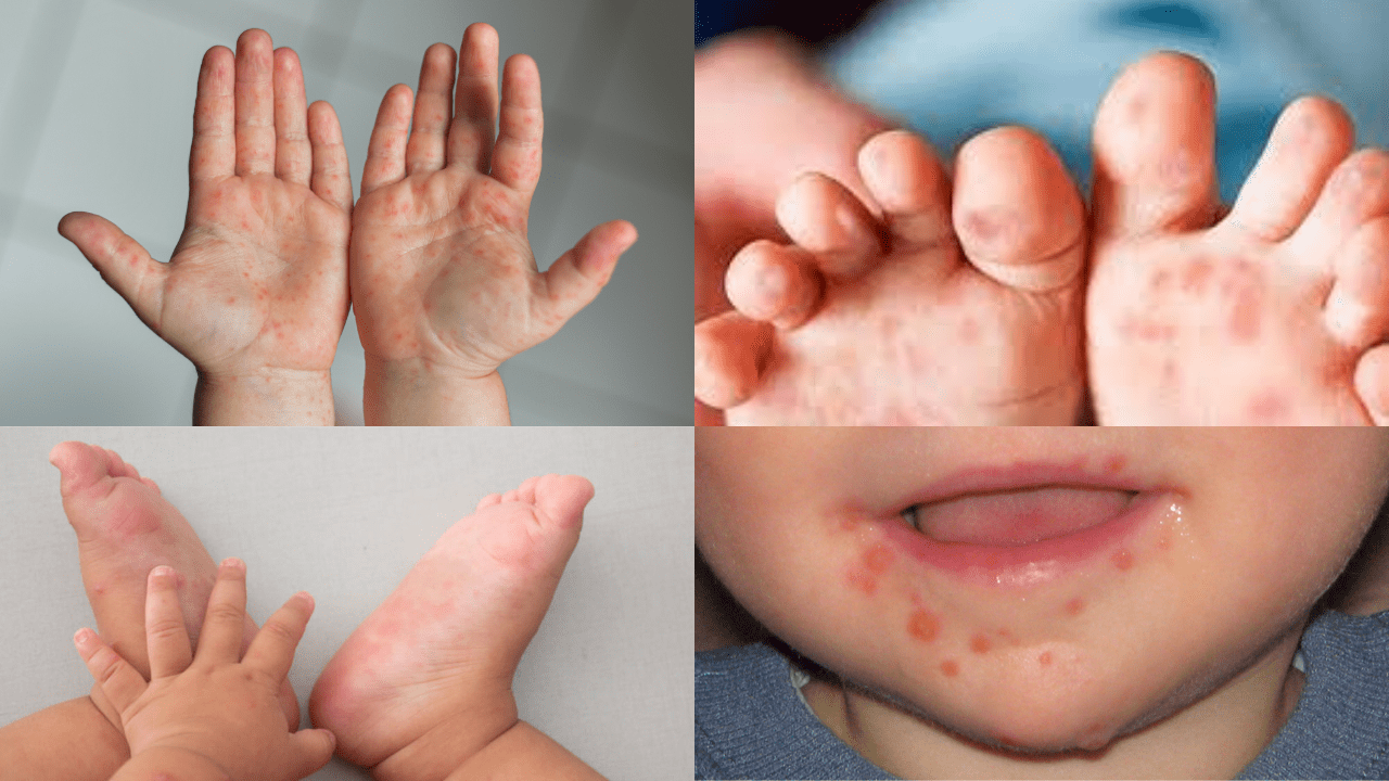 According to Health Direct General, there were 82,846 HFMD cases