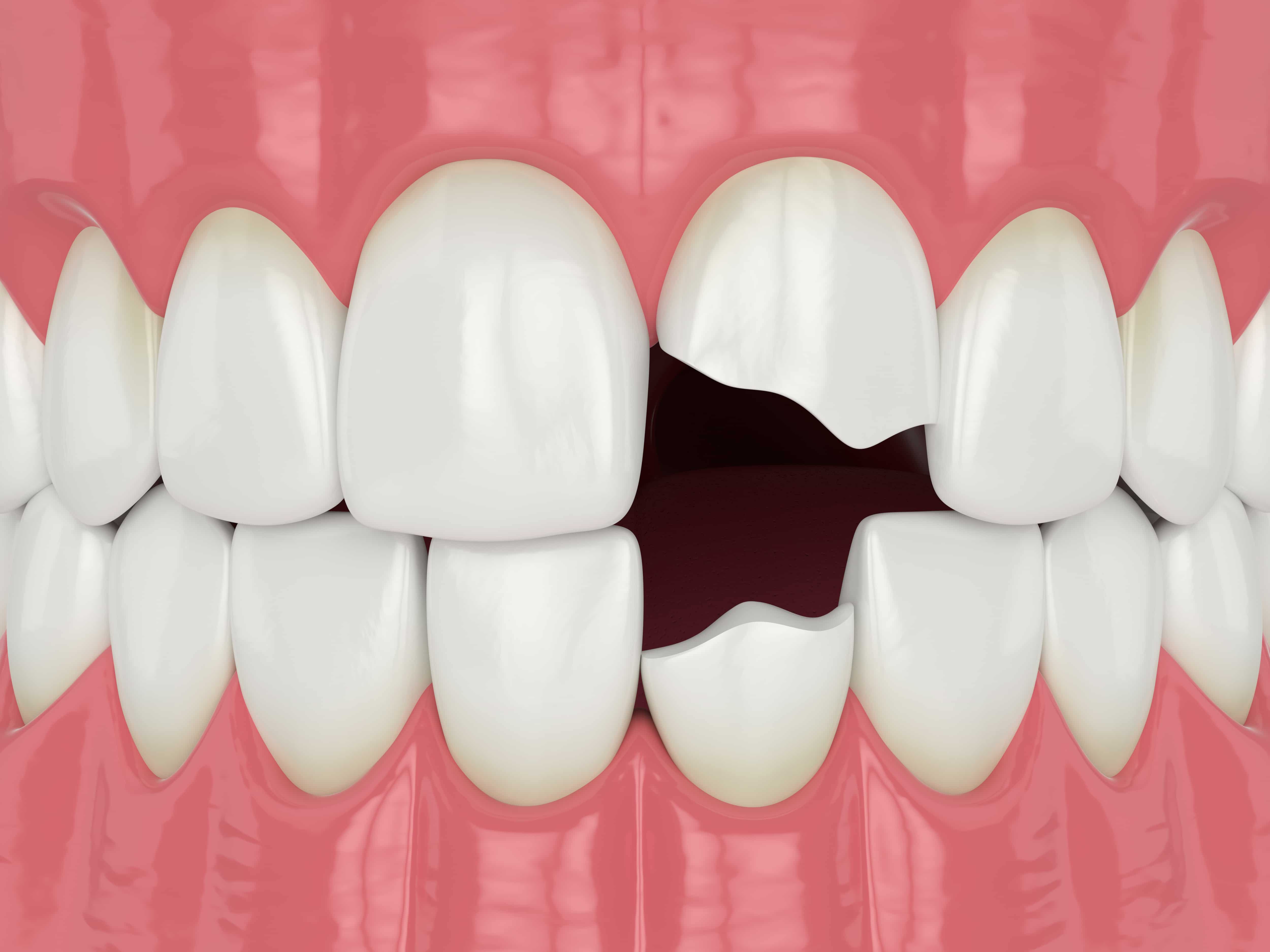 Astoria Dentist Can Fix That Chipped Tooth In One Visit Astoria, NY