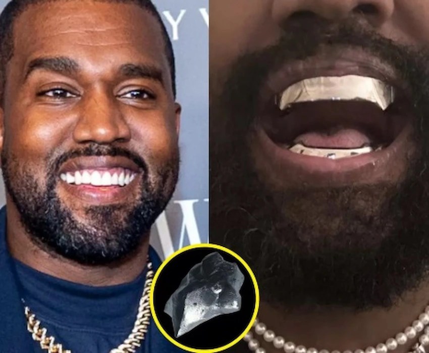 🦷Kanye West New Titanium Teeth and Transformation 2025 Lema