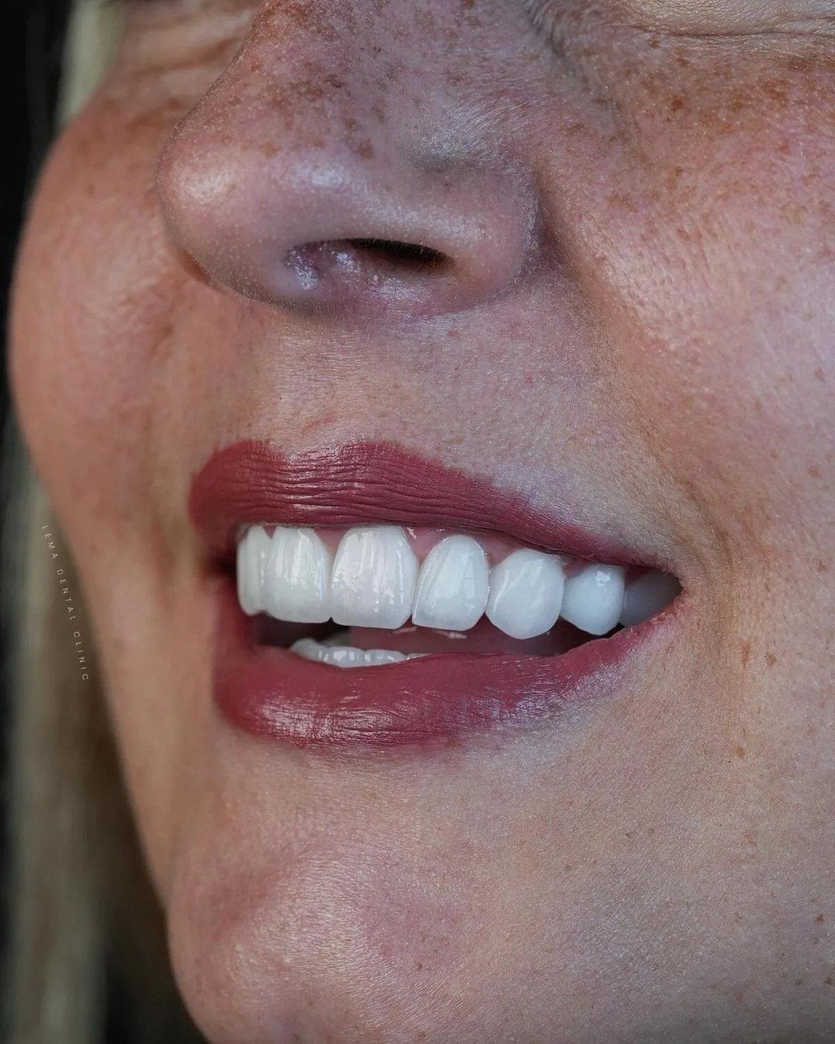 Implant vs. Veneers Smile Makeover