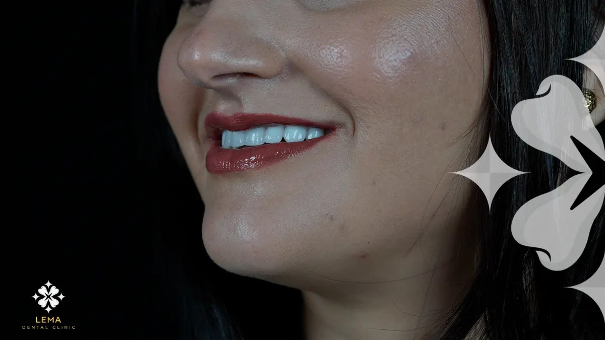 Dental Veneers Cost 2024 Lema Dental Clinic
