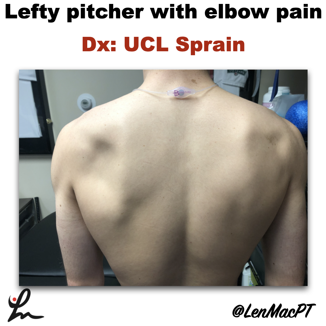 Infraspinatus atrophy in a baseball pitcher with a UCL sprain