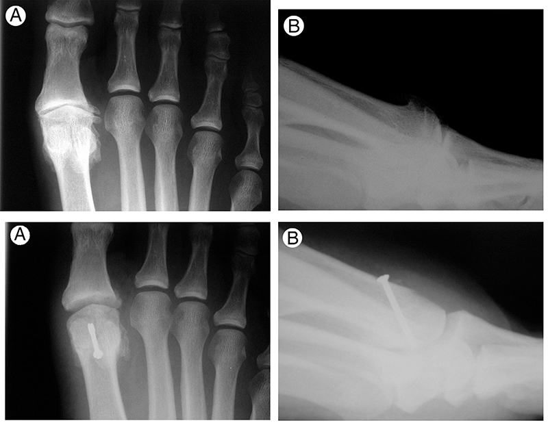 Assessing alternatives to first MTP joint fusion Lower Extremity