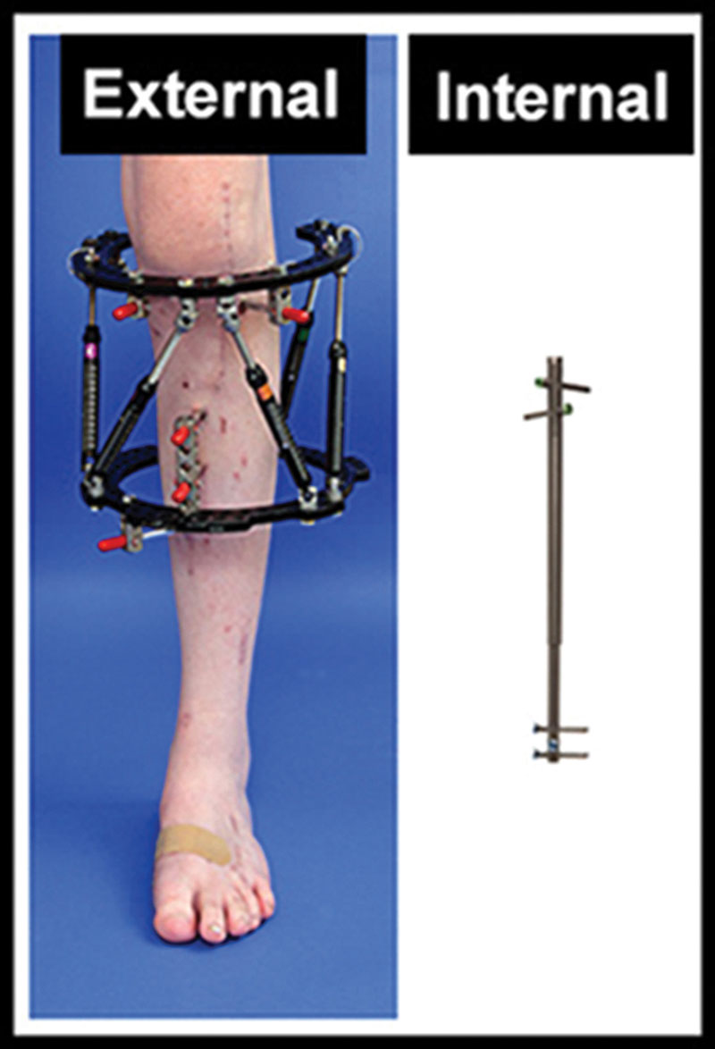 Limb length discrepancy When, how to intervene? Lower Extremity