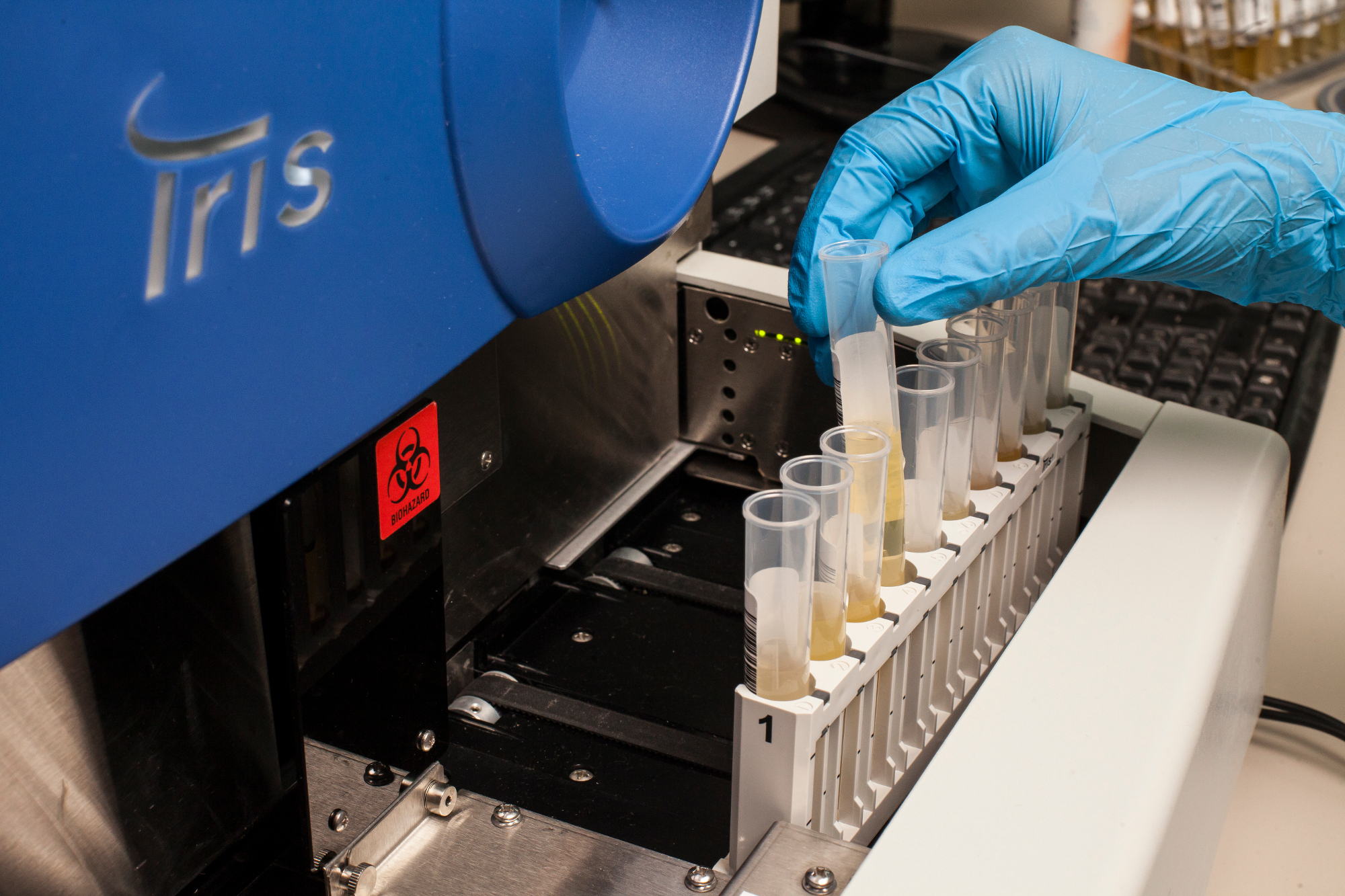 ¿Qué es la proteinuria? LES Laboratorio Especializado del Sur
