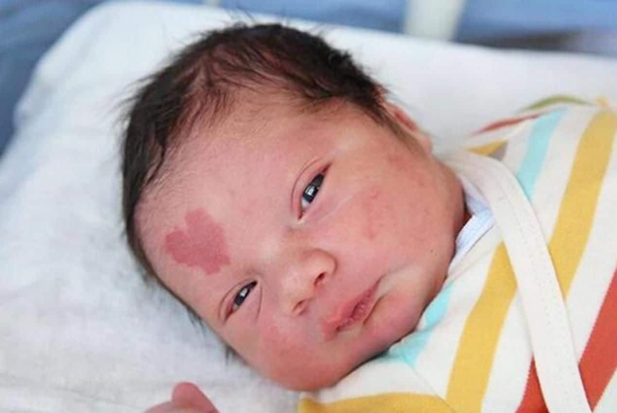 Un bébé naît avec une tâche de naissance en forme de coeur ! 5 ans plus