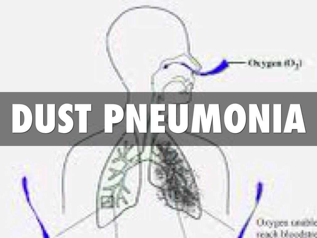 Dust Pneumonia Shocking Facts, Symptoms, Diagnosis & Treatment