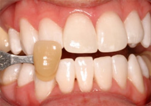 How To Get Rid Of Yellow Stains On Dogs Teeth inspire