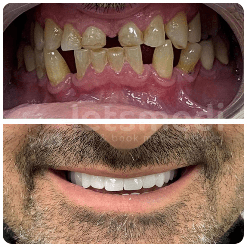 Full Mouth Dental Implants in Turkey Letsmedi