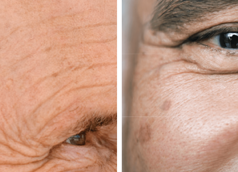 About Actinic Keratosis LEVULAN® KERASTICK® (aminolevulinic acid HCl