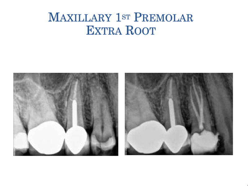Case 02 Lexington Endodontics