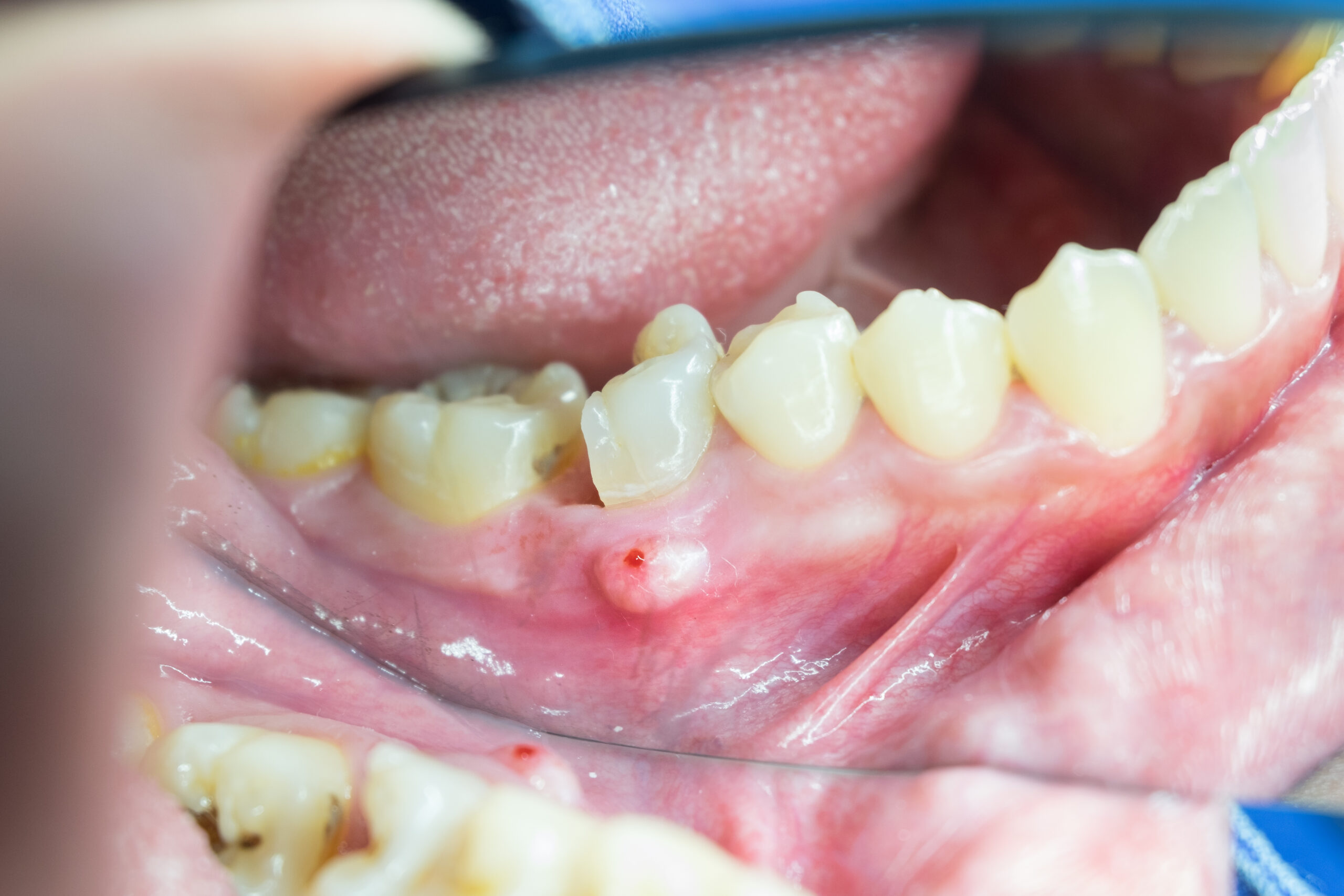 Periapical Diagnoses Lexington Endodontics